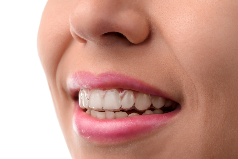 A close-up of a clear aligner straightening teeth
