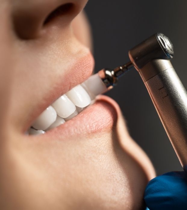 A hygienist polishing a patient's teeth