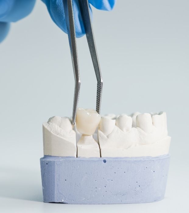 A porcelain dental crown being placed on a model