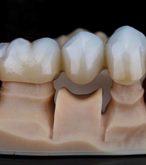A dental bridge restoration on a printed model