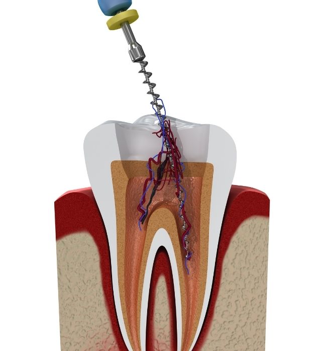 A cross-section model showing root canal treatment