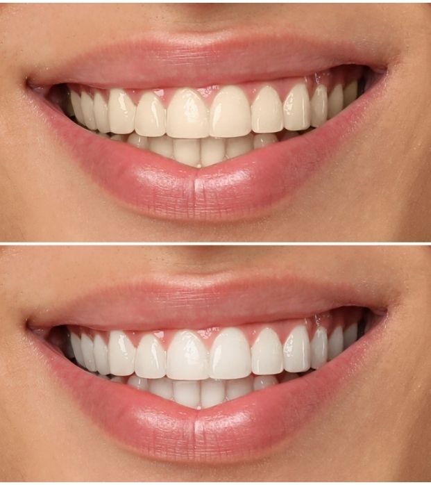 A smile shown before and after professional whitening