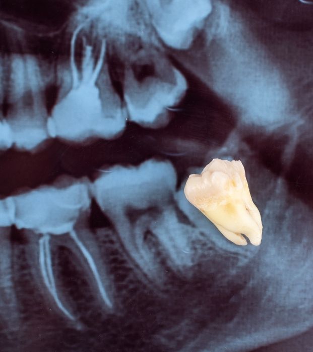 A dental X-ray showing an impacted wisdom tooth