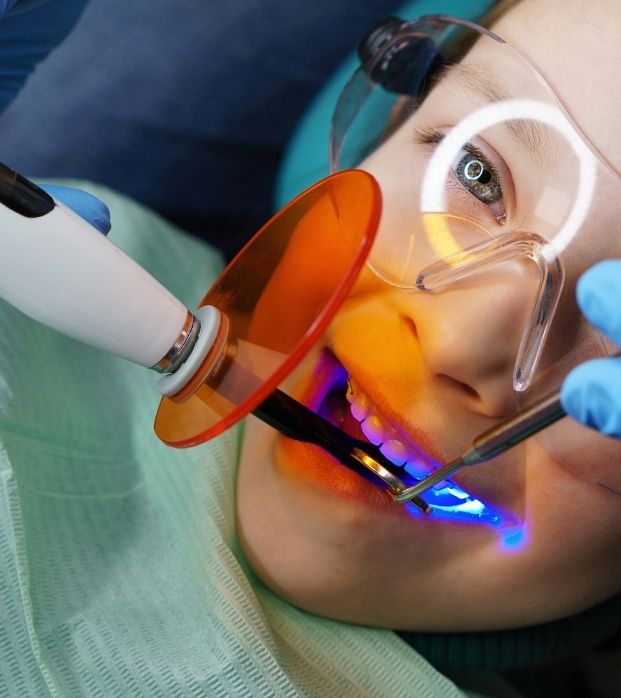 A dentist curing a composite filling with a blue light