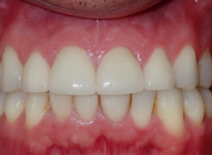 After treatment