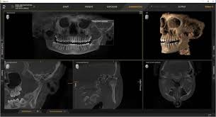 A 3D CBCT image of the teeth and jaw on screen