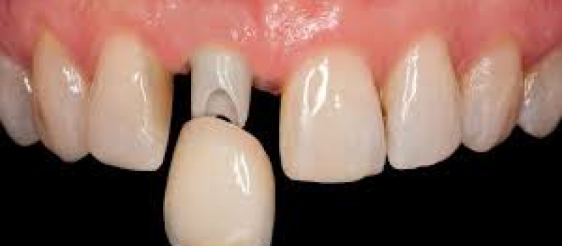 cerec-crown