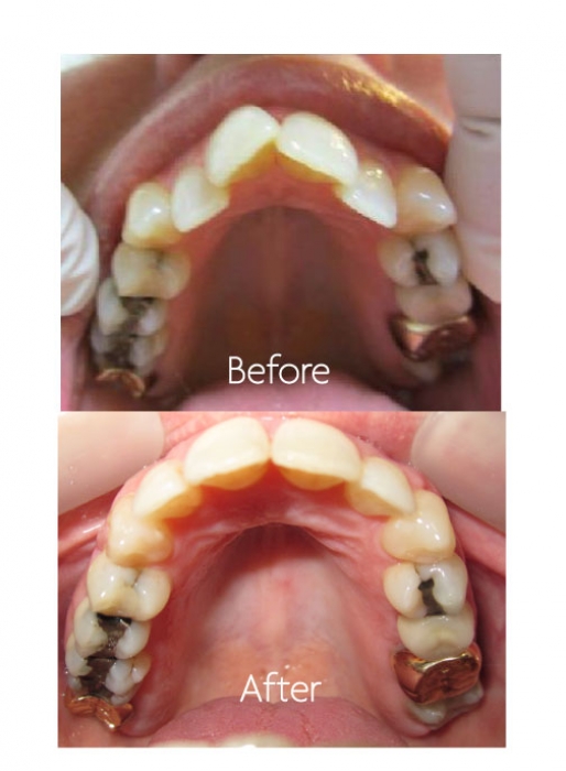 Invisalign® – Invisible Braces - Riverfront Dental